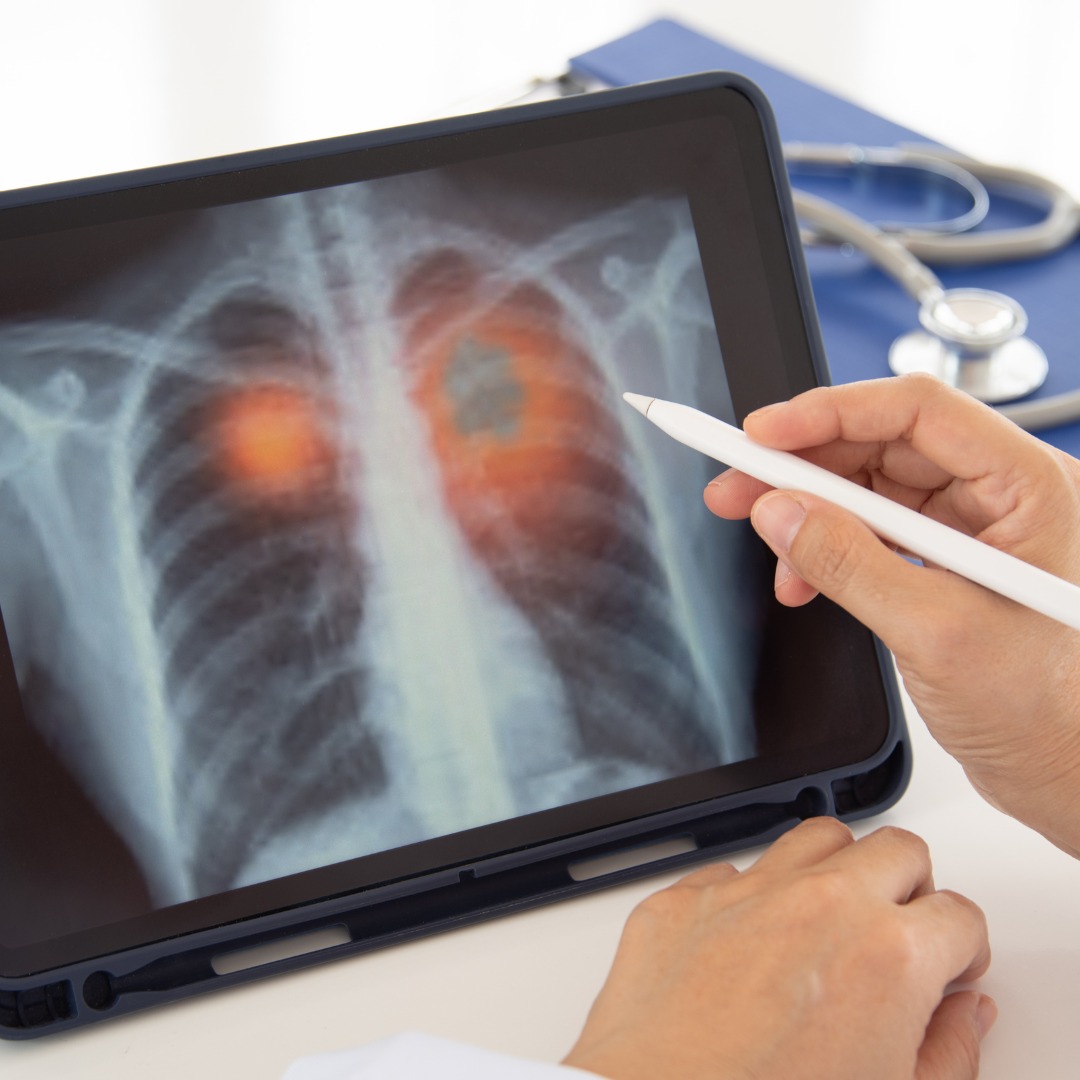Digital x-ray