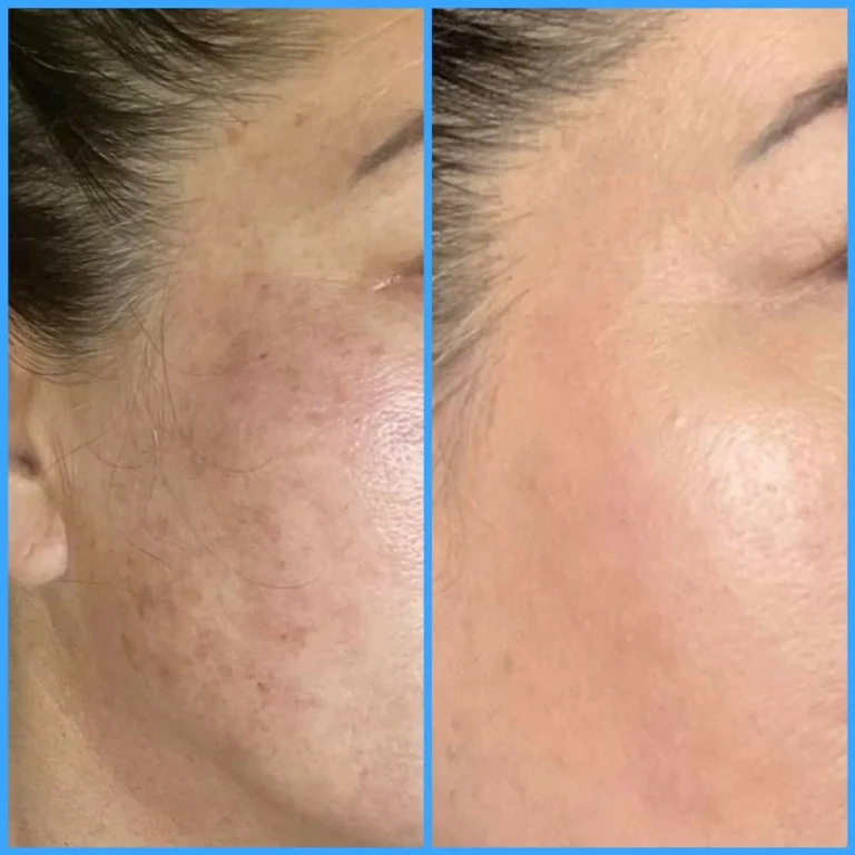 When to Fire Your OTC Skincare: A Dermatologist’s Guide to Permanent Scar Prevention