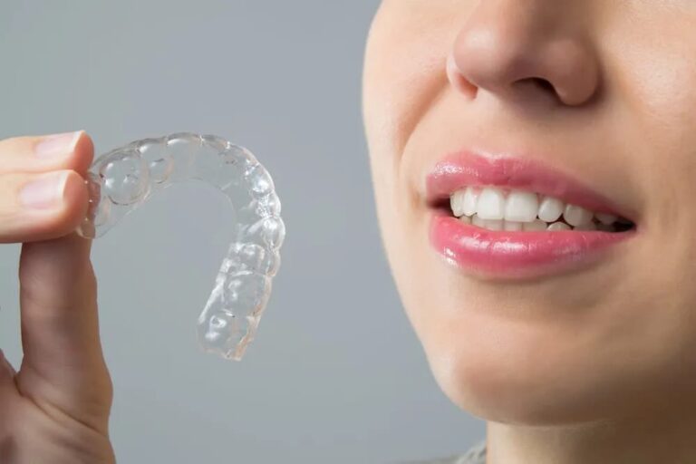 The Complete Invisalign Journey: From Consultation to Your New Smile