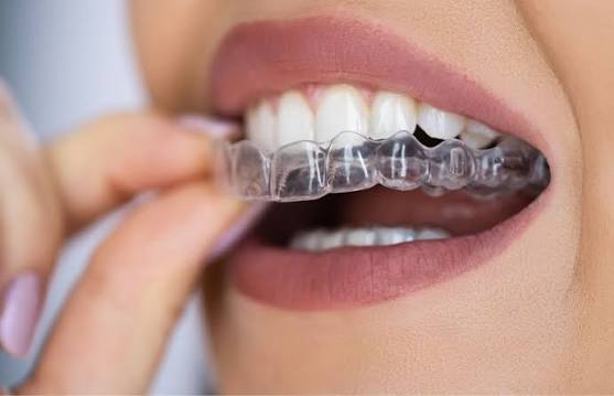Clear Aligners in 2026: Pros, Cons, Real Brand Comparisons, and the Myths Costing People Money