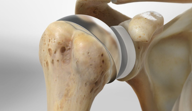 Non-Surgical Treatment Options for a Torn Shoulder Tendon and Knee Arthritis