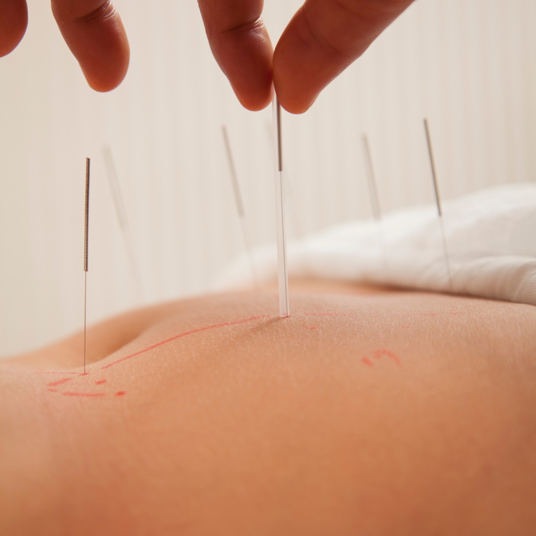 Acupuncture and fertility acupuncture at Health Bloom Bengaluru