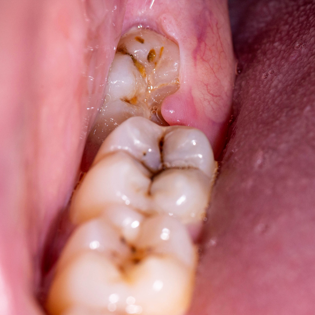 Oral surgery and tooth extraction care at Health Bloom Bengaluru
