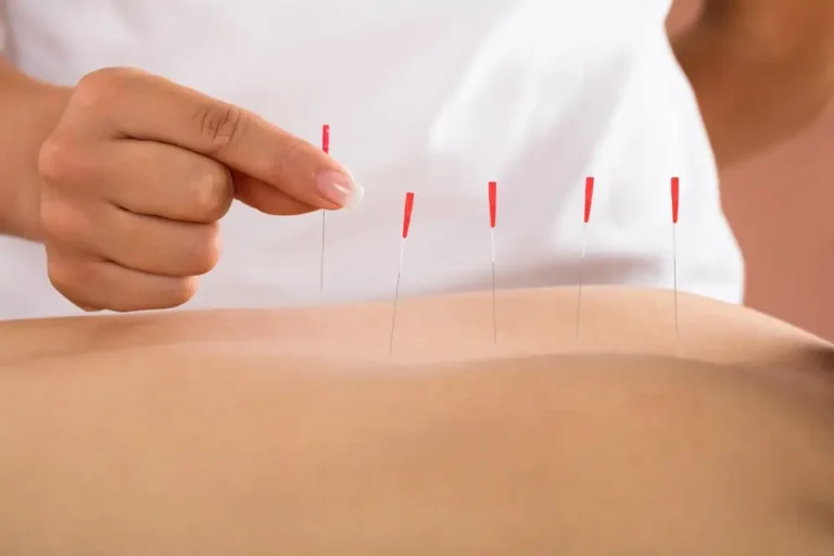Fertility Acupuncture for Getting Pregnant: What You Should Know